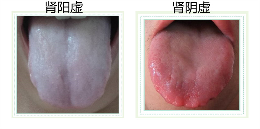 精神萎靡是阴虚还是阳虚？通过舌苔可分辨-第1张图片